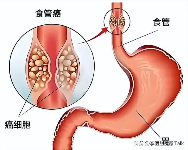 浙江大学分析100名胃癌患者,惊讶发现:患胃癌的人,有7大共性