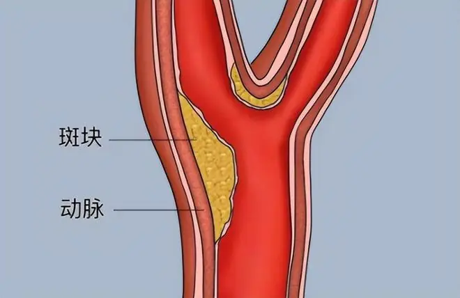医生告诫：一旦确诊颈动脉斑块，6种食物必须戒掉，避免斑块增大