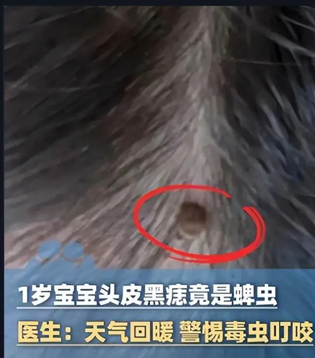蜱虫钻入孩子头皮,家长用手抠没用才送医院,医生怒斥父母:没点常识!蜱虫很毒已经害死很多人了