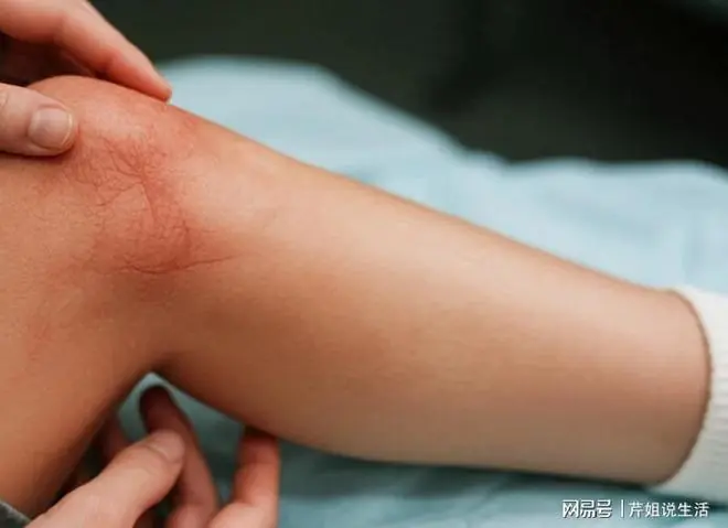 人有没有血栓，散步就知道？体内有血栓的人，散步常有这4个表现