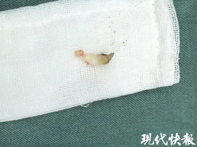 8岁女孩鼻腔反复发炎，竟是牙齿长进了鼻腔